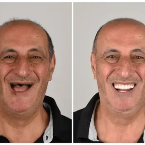 🦷 Denturelix™ Custom-Fit Functional Dentures 😁 Smile with Confidence