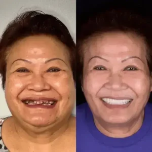 SmileFitPro BioFusion Dentures