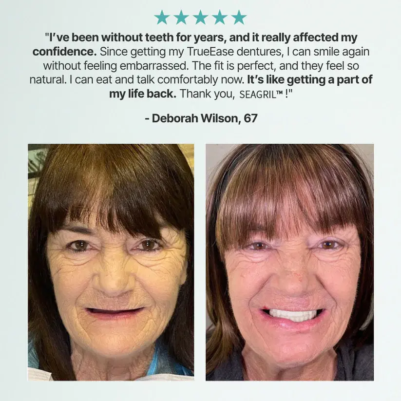 SEAGRIL™ Custom-Fit Full Functional Dentures