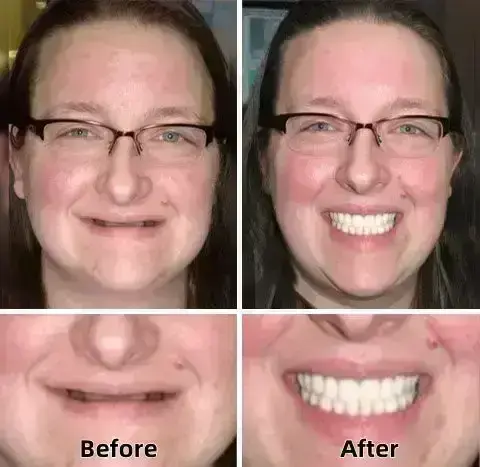 SmileFitPro™–Advanced Custom-Fit Functional Dentures