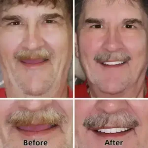 SmileFitPro™–Advanced Custom-Fit Functional Dentures