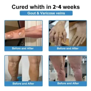 ✅ Official Store: Skavix® Nano-Microneedle Joint Patch