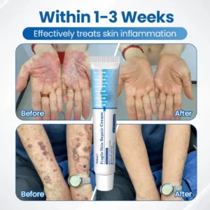 Virexo™ Fragile Skin Repair Cream