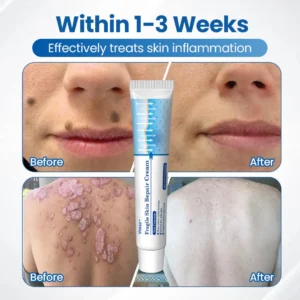 Virexo™ Fragile Skin Repair Cream