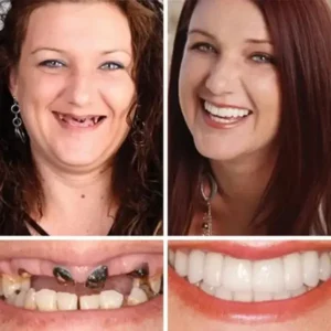 Ends Today: 70% OFF! ⏰70% OFF! FOMONEST™ Medical Full Denture with Strong Suctiond Custom-Fit Full Functional Dentures