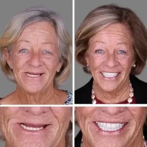 Ends Today: 70% OFF! ⏰70% OFF! FOMONEST™ Medical Full Denture with Strong Suctiond Custom-Fit Full Functional Dentures