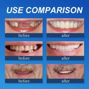 Ends Today: 70% OFF! ⏰70% OFF! FOMONEST™ Medical Full Denture with Strong Suctiond Custom-Fit Full Functional Dentures