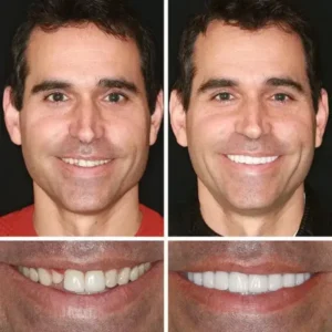 Ends Today: 70% OFF! ⏰70% OFF! FOMONEST™ Medical Full Denture with Strong Suctiond Custom-Fit Full Functional Dentures