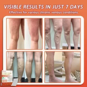 Zvoevo® Vein Ease Microneedle Care Patch