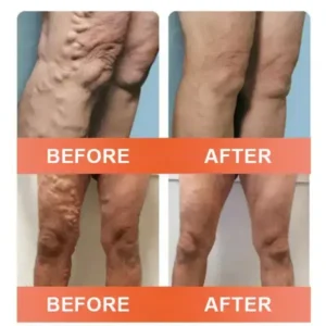 Zvoevo® Vein Ease Microneedle Care Patch