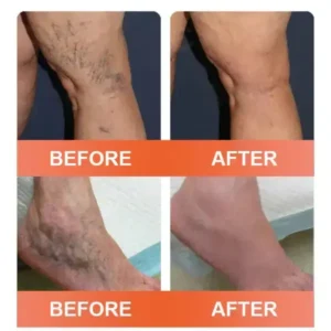 Zvoevo® Vein Ease Microneedle Care Patch
