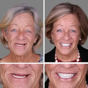 ⏰Ends Today: 50% OFF! 🌎KLENIMORE™ Custom-Fit Dentures— Designed for Comfort and a Natural-Looking Smile