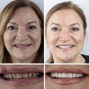 ⏰Ends Today: 50% OFF! 🌎KLENIMORE™ Custom-Fit Dentures— Designed for Comfort and a Natural-Looking Smile