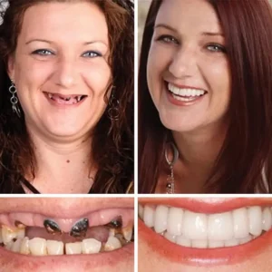 ⏰Ends Today: 50% OFF! 🌎KLENIMORE™ Custom-Fit Dentures— Designed for Comfort and a Natural-Looking Smile