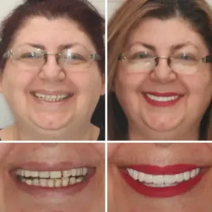 🌟 Vaxflite™ – Custom-Crafted Dentures That Feel as Natural as They Look👩‍🔬