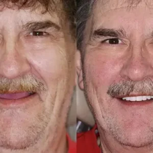 🌟 Vaxflite™ – Custom-Crafted Dentures That Feel as Natural as They Look👩‍🔬