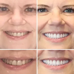 🌟 Vaxflite™ – Custom-Crafted Dentures That Feel as Natural as They Look👩‍🔬