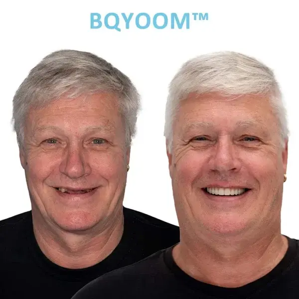 BQYOOM™ GelFit Dentures