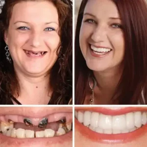 Heaceitr® Premium Full Denture Set